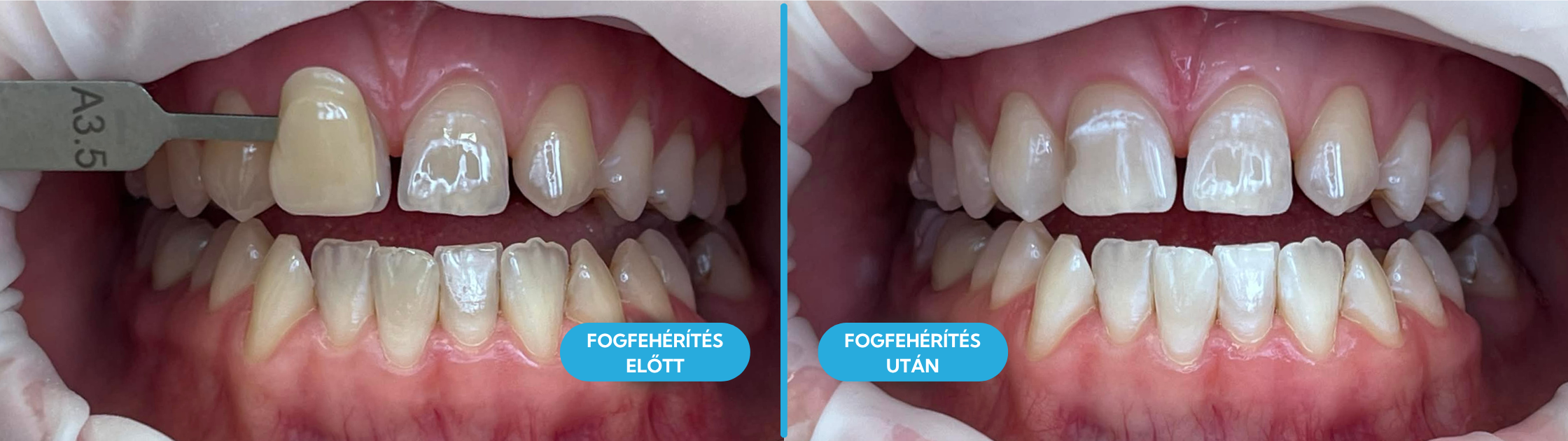 Fogfehérítés itt: Kario-Dent Szeged, fogorvosi rendelő